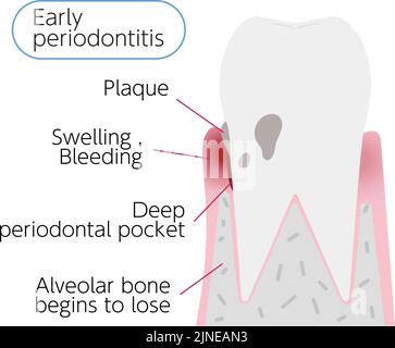 Illustration par étape de la maladie parodontale : parodontite précoce Illustration de Vecteur
