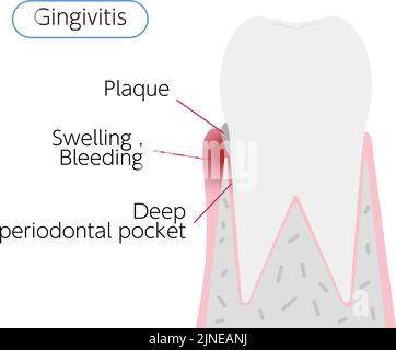 Illustration par stade de la maladie parodontale : gingivite Illustration de Vecteur
