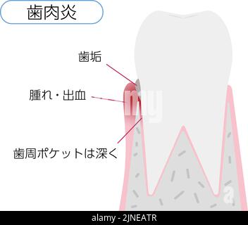 Illustration par étape de la maladie parodontale: Gingivite Traduction: Gingivite, plaque, gonflement / saignement, poches parodontales profondes Illustration de Vecteur