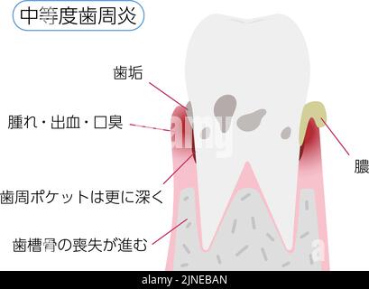 Illustration par étape de la maladie parodontale: Parodontite modérée Traduction: Parodontite modérée, plaque, gonflement / saignement / mauvaise haleine, de Illustration de Vecteur