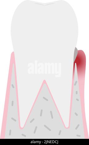 Illustration par stade de la maladie parodontale : gingivite Illustration de Vecteur