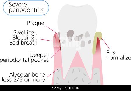 Illustration par étape de la maladie parodontale : parodontite sévère Illustration de Vecteur