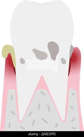 Illustration par étape de la maladie parodontale : parodontite modérée Illustration de Vecteur