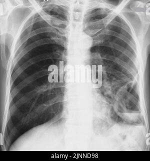 Abcès pulmonaire, rayons X. Banque D'Images