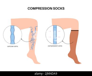 Chaussettes de compression pour varices, illustration Banque D'Images