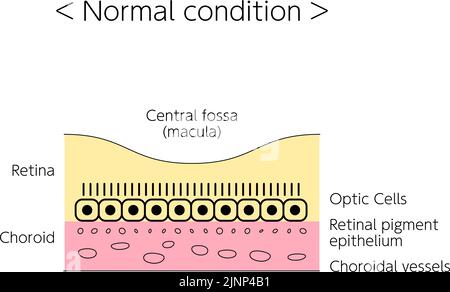 Maladie des yeux, illustration de la dégénérescence maculaire liée à l'âge, normale Illustration de Vecteur