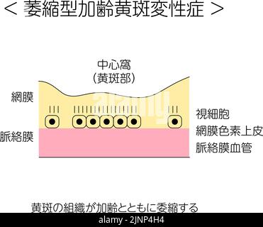 Maladie des yeux, dégénérescence maculaire liée à l'âge atrophique illustrée - Traduction : état normal, dégénérescence maculaire liée à l'âge atrophique, atrophie Illustration de Vecteur