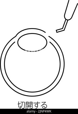 Processus de chirurgie de la cataracte, Illustration (dessin au trait), faire une incision - Traduction: Incision Illustration de Vecteur