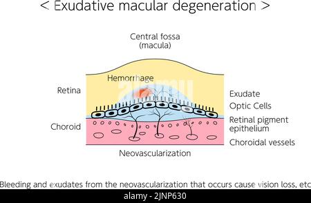 Maladies oculaires, dégénérescence maculaire exsudative liée à l'âge illustrée Illustration de Vecteur