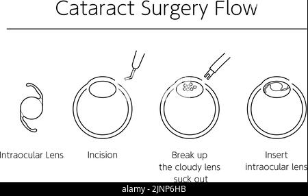 Flux de la chirurgie de la cataracte, illustration illustrée (dessin de ligne) Illustration de Vecteur