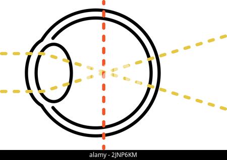 Illustrations médicales des erreurs de vision et de réfraction, par Myopia (Focus en face de la rétine) Illustration de Vecteur