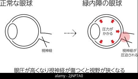 Illustration du fonctionnement du glaucome, yeux normaux et glaucomateux, illustration médicale - Traduction: Œil normal, œil de glaucome, pression, nerf optique, Illustration de Vecteur