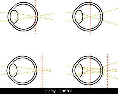 Illustrations médicales de la vision et de l'erreur réfractive, normale, myopie, hypermétropie, astigmatisme Illustration de Vecteur