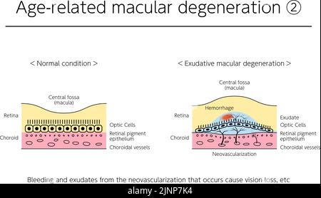 Maladies oculaires, dégénérescence maculaire exsudative liée à l'âge illustrée Illustration de Vecteur