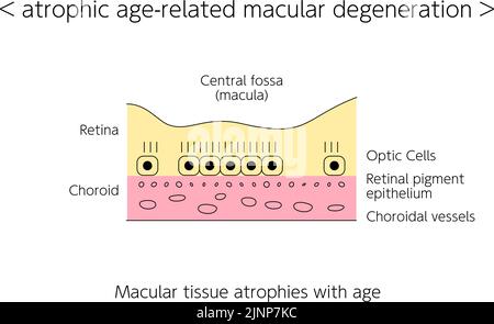 Maladie des yeux, dégénérescence maculaire liée à l'âge atrophique illustrée Illustration de Vecteur