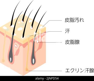 Illustration schématique d'une coupe transversale d'un cuir chevelu sale, isométrique - Traduction: Cuir chevelu sale Illustration de Vecteur