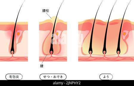 Image des problèmes de peau, peau rugueuse / acné, folliculite précoce à avancée - Traduction: Folliculite, abcès, pus, pustules, pustules / boutons, etc Illustration de Vecteur