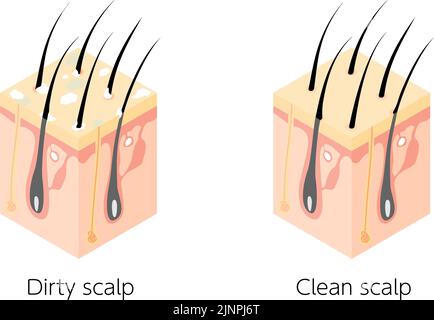Illustration schématique d'une coupe transversale d'un cuir chevelu sale et d'un cuir chevelu propre, isométrique Illustration de Vecteur