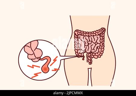 Gros plan du corps humain avec appendice enflammé. La personne souffre d'une appendicite a besoin d'une chirurgie. Illustration vectorielle. Illustration de Vecteur