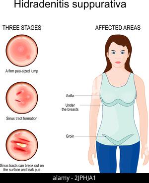 Hidradenitis suppurativa. Zones affectées de l'acné inversa. Trois étapes de la maladie de Verneuil. Gros plan de la peau d'un humain avec formation du tractus sinusal. Illustration de Vecteur