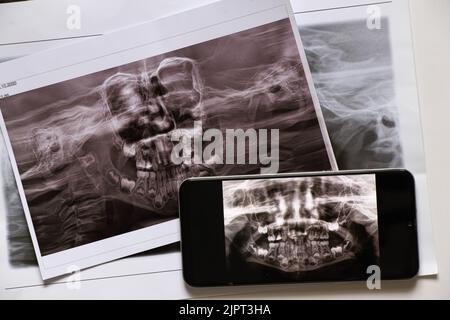 La prise de vue panoramique montre plusieurs dents incrustées et impactées sur la mâchoire supérieure et inférieure des dents des enfants sur les écrans du téléphone, application mobile Banque D'Images