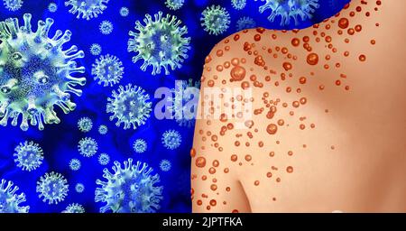 Virus de la pox de singe ou de la variole du singe comme une infection contagieuse sous forme de cloques et de laisons sur la peau représentant la transmission d'une personne infectée Banque D'Images