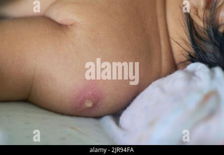 Un petit bébé avec un point de vaccination sur son épaule. Banque D'Images