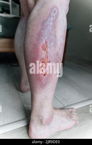 Cicatrices sur sa jambe Photo Stock - Alamy