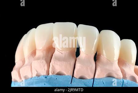 Les facettes en céramique et les couronnes de la presse à l'aspect naturel sur le modèle de plâtre dentaire. Gros plan sur la couronne dentée en céramique. Atelier de fabrication de prothèses dentaires Banque D'Images