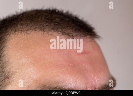 Focus sélective gros plan d'un homme caucasien à poil court et brun sur le front avec une petite cicatrice. Banque D'Images