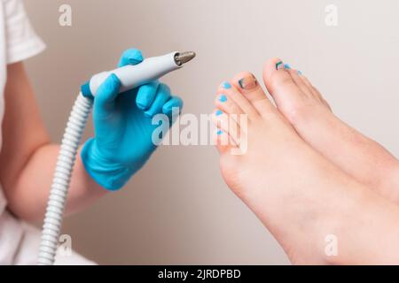 Chiropodiste tenant une poignée de matériel peeling. Gros plan des pieds femelles avec des orteils incarnés. Le concept de pédicure professionnelle en podologie clin Banque D'Images