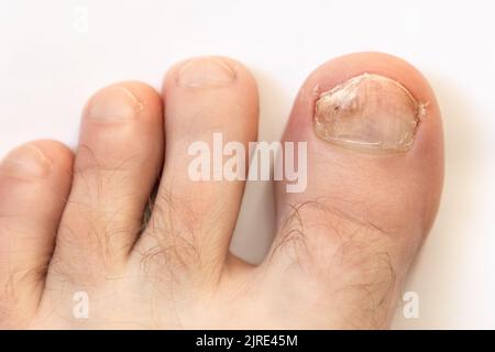 Le pied d'un homme avec un ongle endommagé endommagé par le champignon. Vue de dessus. Arrière-plan blanc. Le concept de pédiatrie et de chiropodie. Banque D'Images