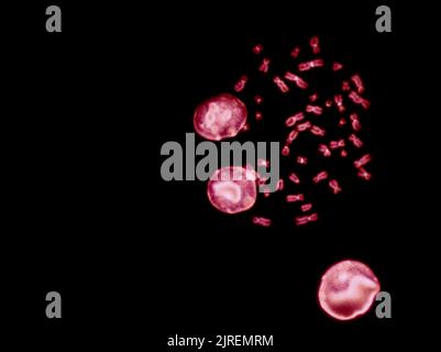 Chromosomes sous microscope à fluorescence, chromosomes humains de couleur rouge provenant du sang Banque D'Images