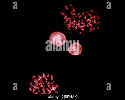 Chromosomes sous microscope à fluorescence, chromosomes humains de couleur rouge provenant du sang Banque D'Images