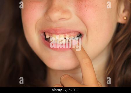 la petite fille ouvre sa bouche et montre une dent malade. caries sur une dent de bébé. Soins des dents des enfants. Dents et caries endommagées Banque D'Images