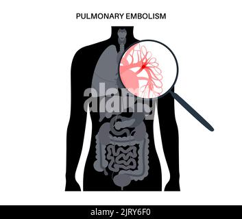 L'embolie pulmonaire, illustration Banque D'Images