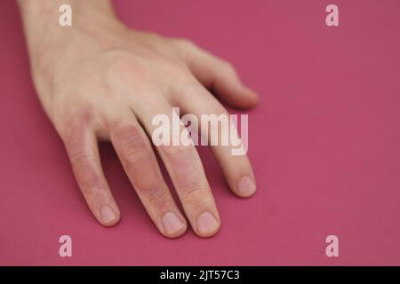 Homme avec brûlure sur sa main, gros plan. Brûler le blister sur la main. Main mâle avec des cloques dues à des brûlures. Banque D'Images