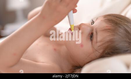 Enfant avec la varicelle au lit avec thermomètre Banque D'Images