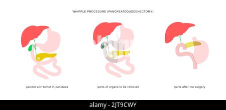 Infographie médicale de la procédure de whipple pancréaticoduodénectomie avec gastrojéjunostomie. Opération chirurgicale dans le traitement du cancer du pancréas. Illustration de Vecteur