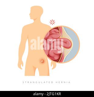 Hernie étranglée - Section des petits intestins - Illustration du stock comme fichier EPS 10 Illustration de Vecteur