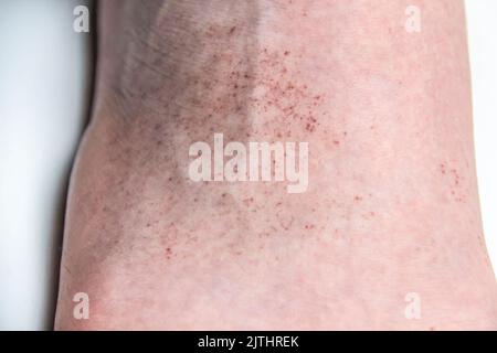 Une éruption rouge sur le pied d'un homme contre le fond. Gros plan sur une partie de la jambe avec une éruption allergique rouge. Peau allergique Banque D'Images