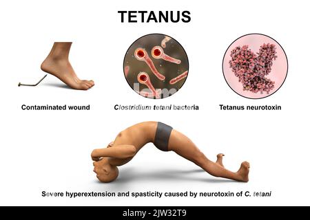 Mécanisme de la maladie tétanique, illustration. Une plaie cutanée est contaminée par la bactérie Clostridium tetani qui produit une neurotoxine qui atteint la moelle épinière et provoque la paralysie spastique. L'homme est en opisthotonus (spasme rétrograde), un état d'hyperextension et de spasticité sévères. Banque D'Images