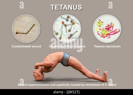 Mécanisme de la maladie tétanique, illustration. Une plaie cutanée est contaminée par la bactérie Clostridium tetani qui produit une neurotoxine qui atteint la moelle épinière et provoque la paralysie spastique. L'homme est en opisthotonus (spasme rétrograde), un état d'hyperextension et de spasticité sévères. Banque D'Images