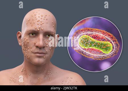 Patient avec la variole (variola) et gros plan d'un virus de la variole, illustration. La variole est une maladie qui provoque de la fièvre et souvent la mort. Il a été éradiqué après un effort mondial en 1970s, mais des souches existent dans les laboratoires de recherche. Des lésions cutanées similaires peuvent être trouvées dans les virus actuellement disponibles de la famille des Poxviridae, comme la variole du singe, qui ont également la même morphologie de virion. Banque D'Images