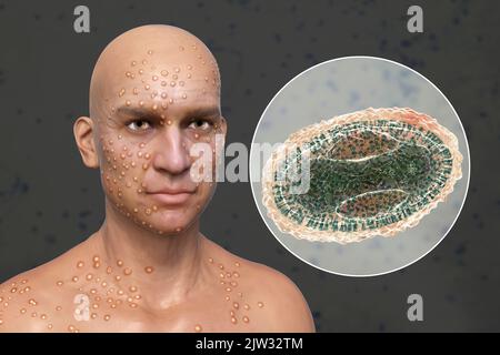 Patient avec la variole (variola) et gros plan d'un virus de la variole, illustration. La variole est une maladie qui provoque de la fièvre et souvent la mort. Il a été éradiqué après un effort mondial en 1970s, mais des souches existent dans les laboratoires de recherche. Des lésions cutanées similaires peuvent être trouvées dans les virus actuellement disponibles de la famille des Poxviridae, comme la variole du singe, qui ont également la même morphologie de virion. Banque D'Images