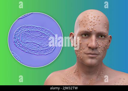 Patient avec la variole (variola) et gros plan d'un virus de la variole, illustration. La variole est une maladie qui provoque de la fièvre et souvent la mort. Il a été éradiqué après un effort mondial en 1970s, mais des souches existent dans les laboratoires de recherche. Des lésions cutanées similaires peuvent être trouvées dans les virus actuellement disponibles de la famille des Poxviridae, comme la variole du singe, qui ont également la même morphologie de virion. Banque D'Images