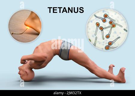 Mécanisme de la maladie tétanique, illustration. Une plaie cutanée est contaminée par la bactérie Clostridium tetani qui produit une neurotoxine qui atteint la moelle épinière et provoque la paralysie spastique. L'homme est en opisthotonus (spasme rétrograde), un état d'hyperextension et de spasticité sévères. Banque D'Images