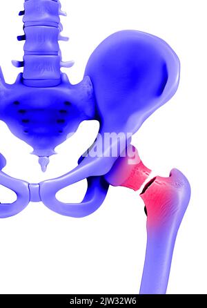 Illustration montrant une fracture dans le cou du fémur (os de la cuisse). Banque D'Images