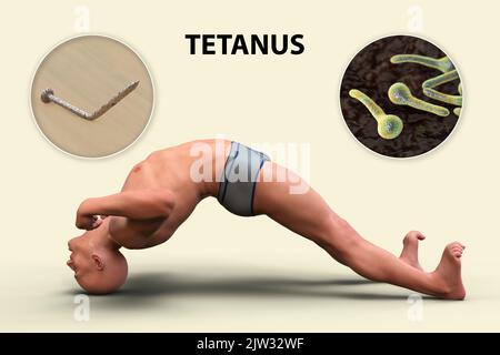 Mécanisme de la maladie tétanique, illustration. Une plaie cutanée est contaminée par la bactérie Clostridium tetani qui produit une neurotoxine qui atteint la moelle épinière et provoque la paralysie spastique. L'homme est en opisthotonus (spasme rétrograde), un état d'hyperextension et de spasticité sévères. Banque D'Images