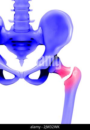 Illustration montrant une fracture dans le cou du fémur (os de la cuisse). Banque D'Images